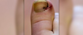 Nail infection treatment