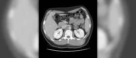 Natural cure fibroid tumors