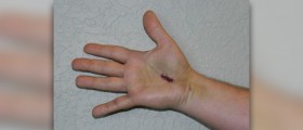 Natural cure for carpal tunnel