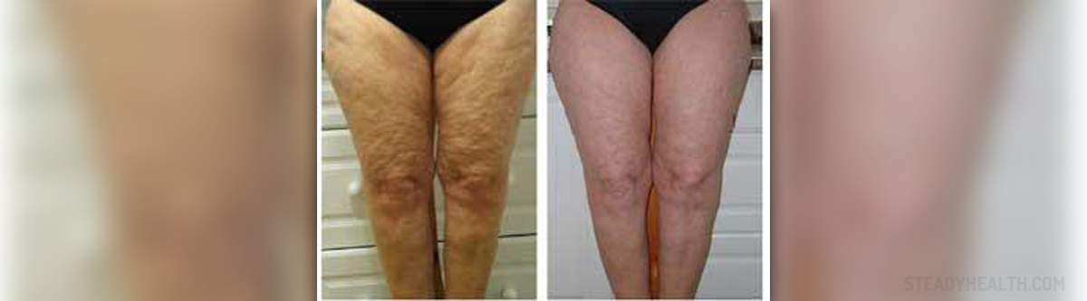 cure cellulite