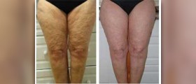 Natural cure for cellulite