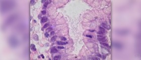 Natural cure for gastritis