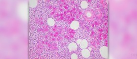 Natural cure for lymphoma