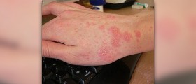 Natural cure for scabies
