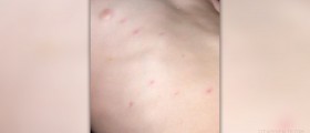 Natural cure for skin rash