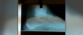 Natural for cure bone spur