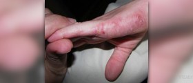 Natural relief from the signs and symptoms of eczema