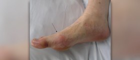 Natural remedies for gout