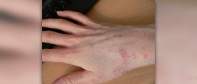 Natural treatment for scabies