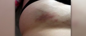 Natural way to get rid of stretch marks