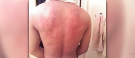 New natural hives treatment options