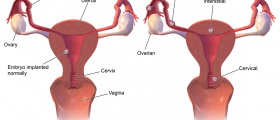 Chances of getting pregnant after ectopic pregnancy