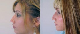 Nose surgery