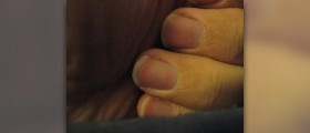Numb fingertips problem