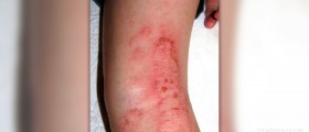 Nummular eczema symptoms