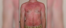 Oatmeal bath for sunburn
