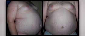 Obesity treatment options