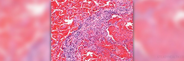 Ocular complications of wegener's granulomatosis