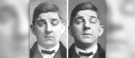 Ocular myasthenia gravis