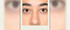 Oily face remedies