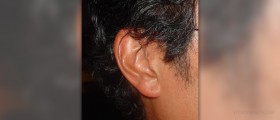 Open ear hearing aids