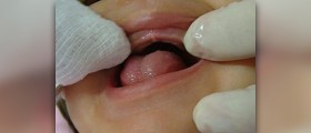 Oral HCG facts