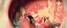 Thrush symptoms in babies