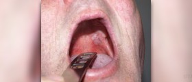 Oral yeast infection: symptoms and treatment