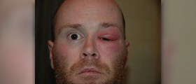 Orbital infection: MRI scan of the eyes