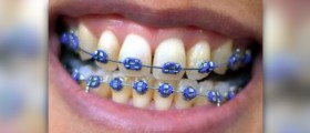 Orthodontic braces for crooked teeth