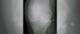 Osteoarthritis of knee review