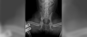Osteosarcoma bone cancer treatment abroad