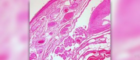 Ovarian cyst medications do not work in the long run
