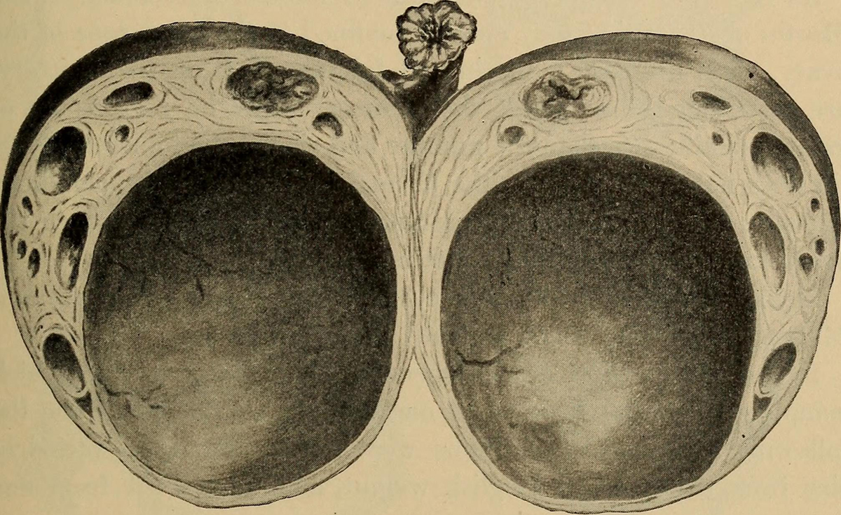 symptoms-of-ruptured-ovarian-cysts-uncovered-general-center