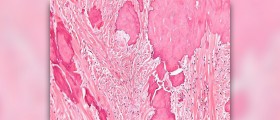 Ovarian cyst surgery may not be required