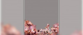 Ovarian dermoid cyst