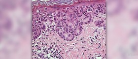 Paget's disease of the breast