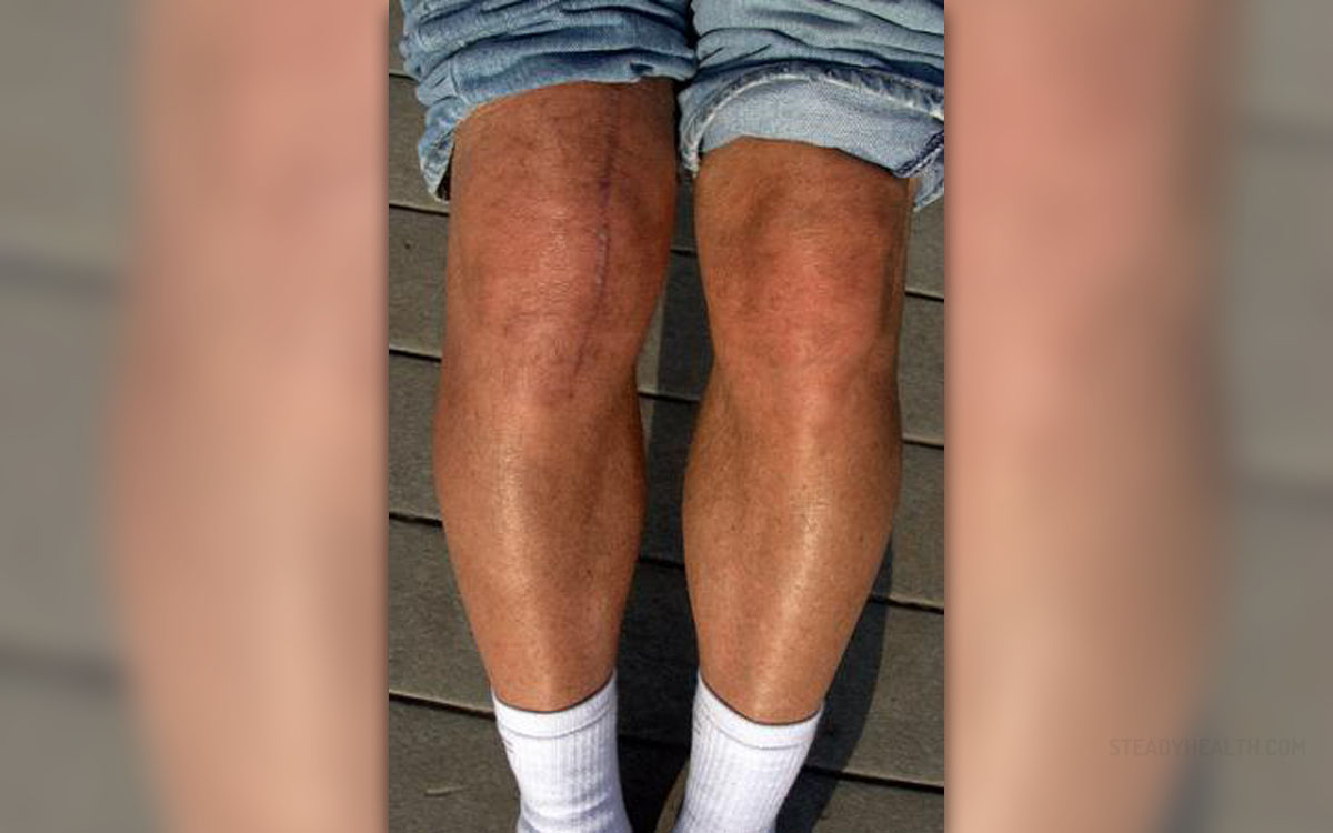 Sharp Pain Above Knee Cap When Walking