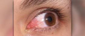 Pain behind eye