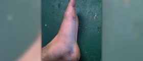 Pain in arch of foot when walking