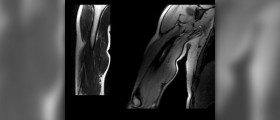 Pain in bicep