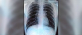 Pain in chest