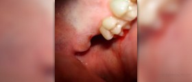 Pain in dental crown