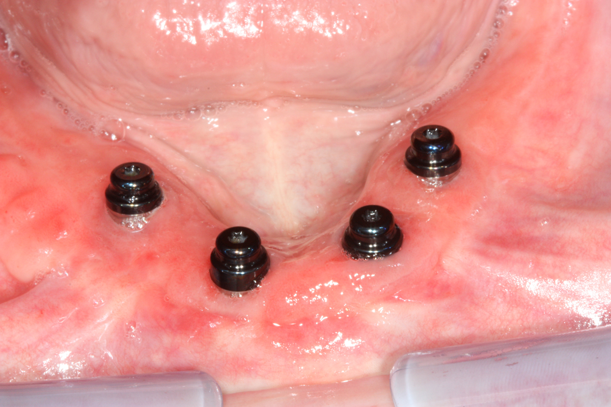 pain-in-dental-implant-general-center-steadyhealth