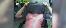 Painful and itchy sunburn