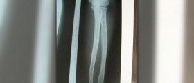 Painful left arm
