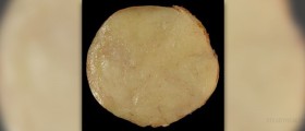 Painful lipoma issue