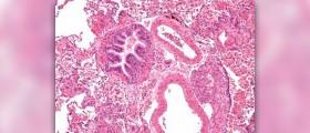 Painful lymph nodes