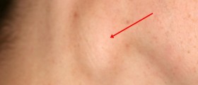 Painful lymphadenopathy