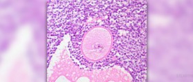 Painful ovary info